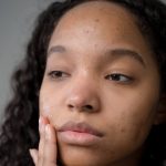 A girl showing Acne on black skin that can be seen on her face which is making her upset