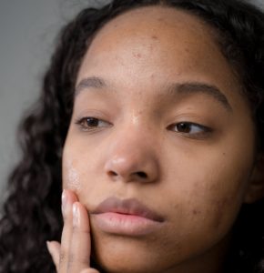 A girl showing Acne on black skin that can be seen on her face which is making her upset