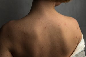 A women suffering from Pregnancy Acne showing her back filled with several acne