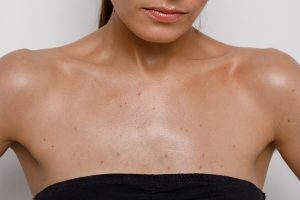 Pregnancy Acne, a women showing her chest and shoulder area that is affected by acne