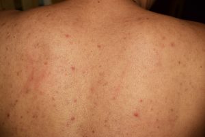 Women showing her back Pregnancy Acne
