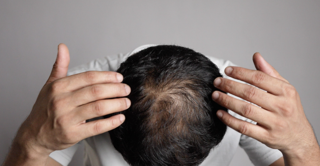 Man showing his head for male pattern hair loss - Oral Minoxidil
