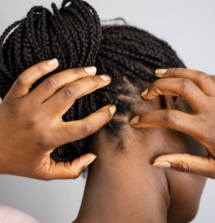 A women with problem of itchy scalp. My Skin of Color, a virtual dermatologist in New York and Florida state, offers treatment for itchy scalp