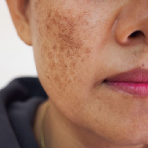 A woman with Melasma receiving treatment from a Virtual Dermatologist in NYC named My Skin of Color