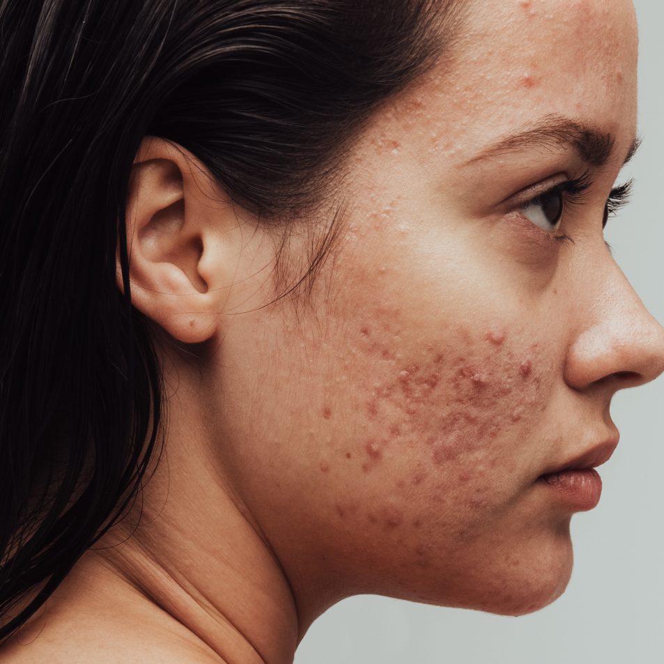 Portrait of woman having acne inflammation on face and body. Rear view close up of woman with pimples on face. Treatment of which is available with My Skin of Color, a virtual dermatologist in NYC